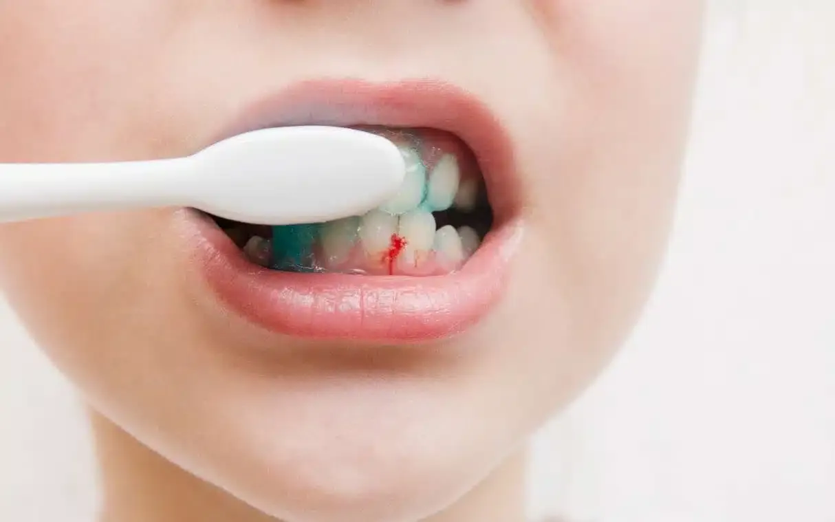 Gums Bleed